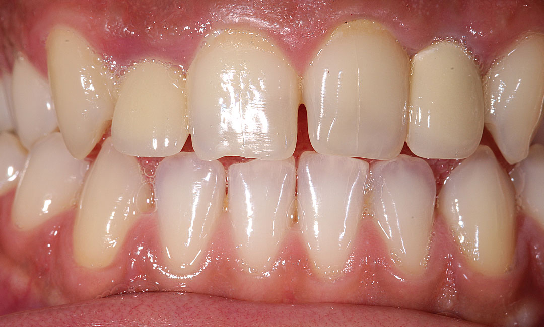 Crowns with Crown Lengthening